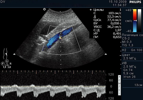 Узи почек с доплером. Стеноз почечной артерии на УЗИ. УЗИ-измерение кровотока почки. УЗИ сосудов почек норма кровоток. Измерение почек на УЗИ.