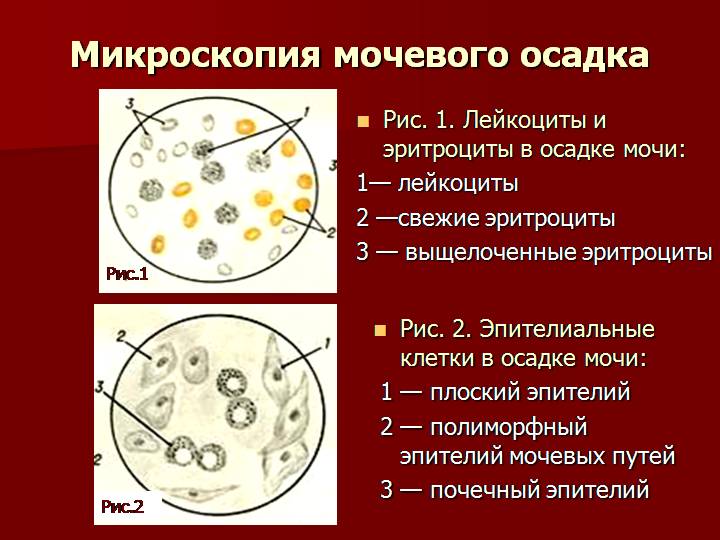 Повышенные в моче белок лейкоциты эритроциты. Лейкоциты в моче микроскопия. Микроскопия мочи норма микроскопия осадка. Эритроциты примикроскопии осдка мочи. Лейкоциты и эритроциты в моче микроскопия.