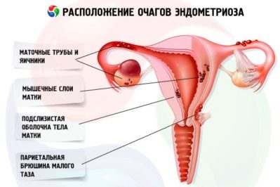 эндометриоз ошақтары