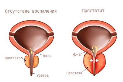 простата безінің қабынуы