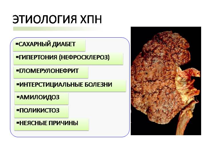 Хроническая болезнь почек картинки