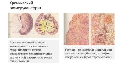 хронический гломерулонефрит