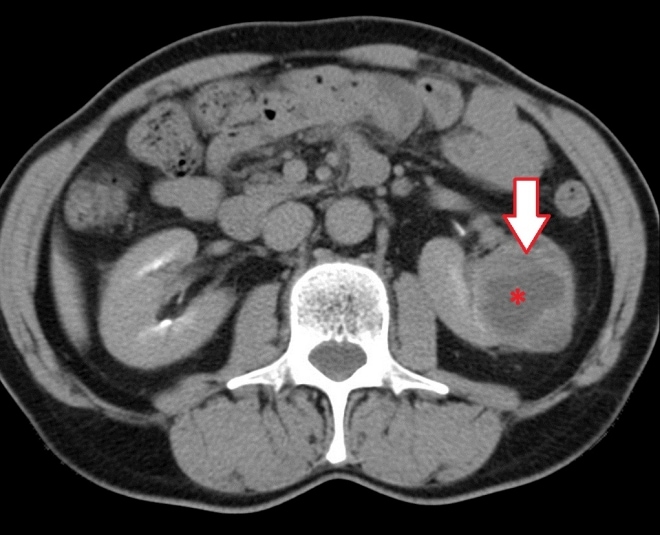 Кт картина са левой почки