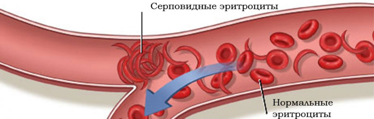 Ген серповидноклеточной анемии