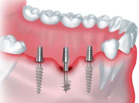 Имплантация зубов - как шанс все исправить