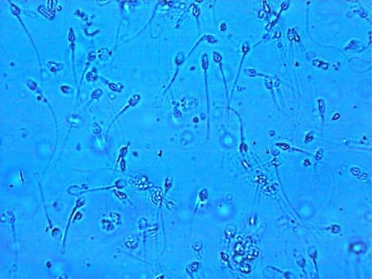 Сперматозоидтарды электронды микроскопиялық зерттеу (EMIS) дегеніміз не
