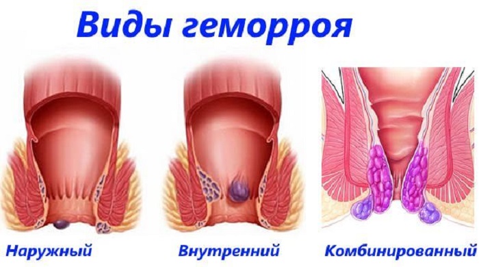 Геморрой - аурудың белгілері және емдеу әдістері