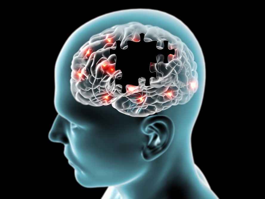 Альцгеймер ауруының 5 ерте белгілері