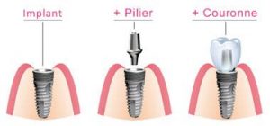 Различные компоненты зубного имплантата