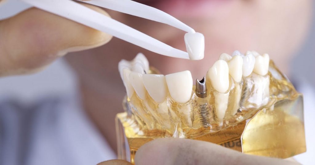 Протезирование зубов и его нюансы
