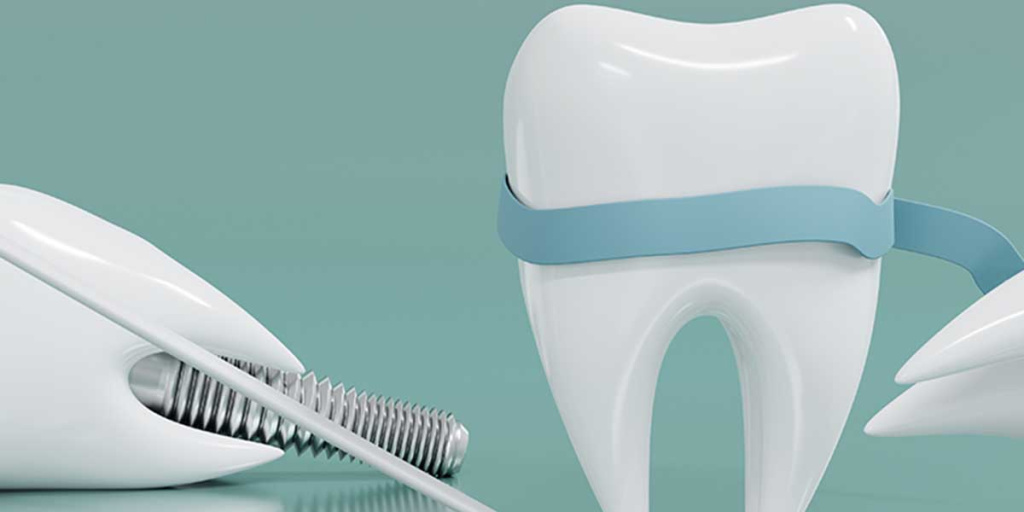 Преимущества услуги по имплантации зубов