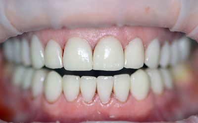 Пластмассовые коронки для зубов