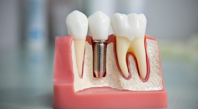 Причины использования зубных имплантатов