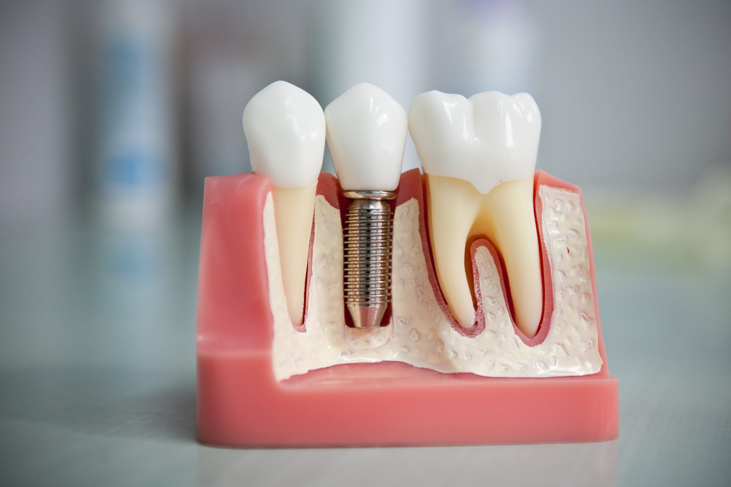 Причины использования зубных имплантатов