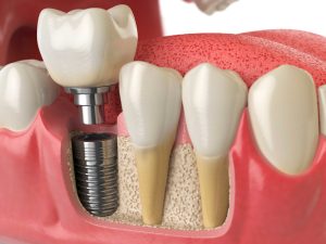 Имплантоводы: незаменимые помощники в имплантации зубов